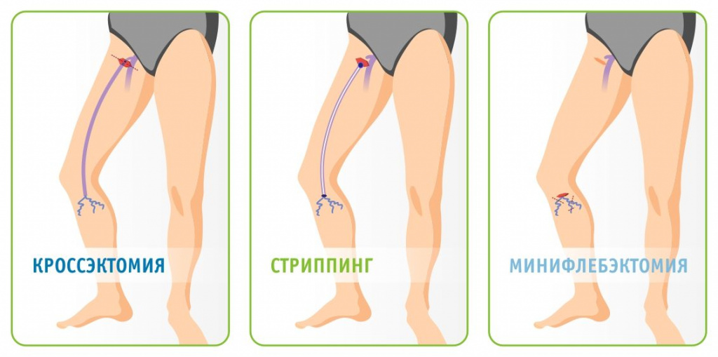 Три этапа флебэктомии